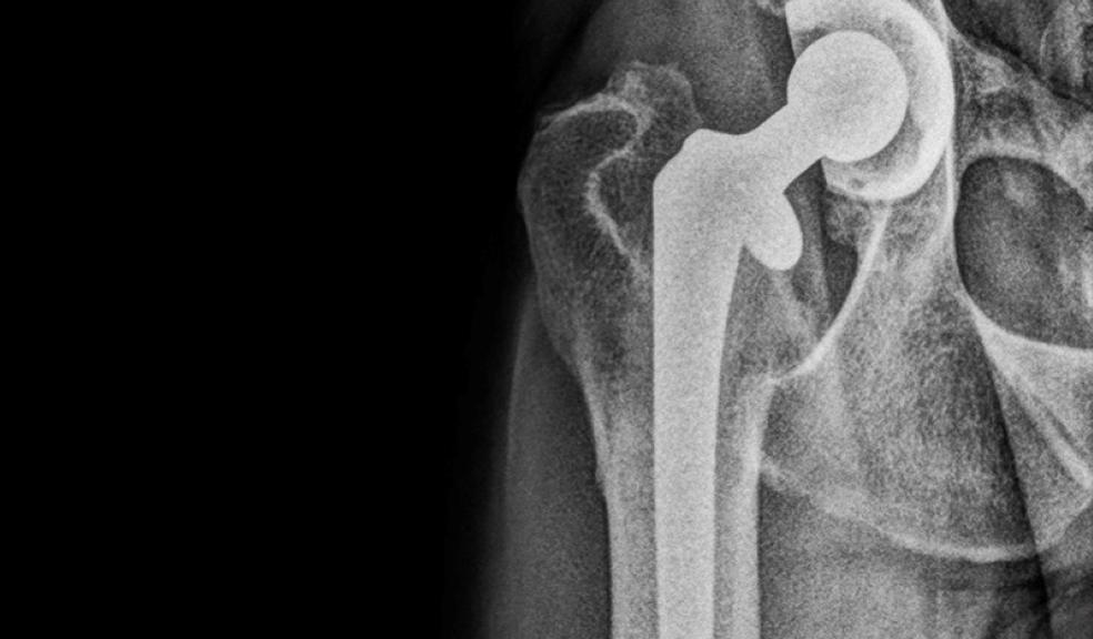 X-ray of a hip replacement X-ray of a hip replacement